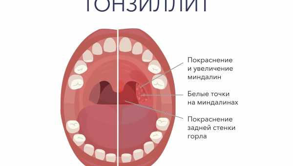 Боль в горле у ребенка: чем лечить