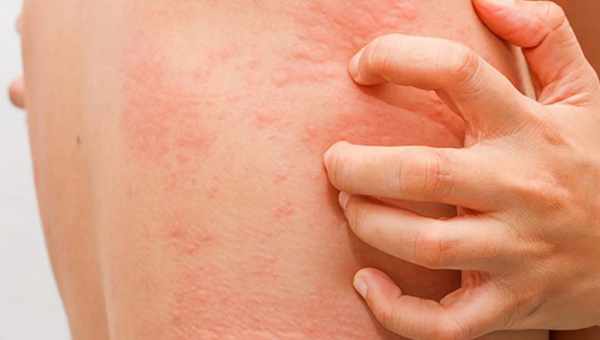 Что делать, если у грудничка аллергия на пыль