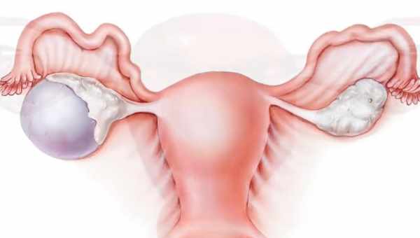 Лечение кисты яичника народными средствами: налаживаем женское здоровье. Как вылечить кисту яичника без операции?
