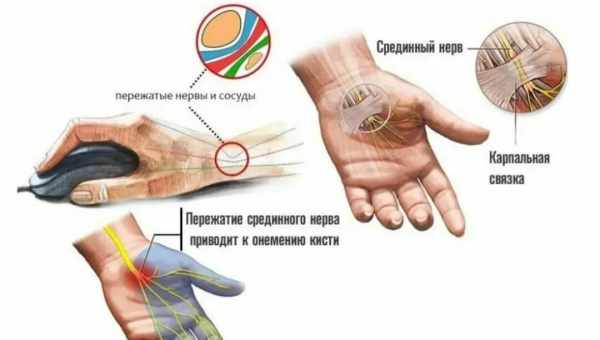 Боль в суставах правой и левой руки – причины. Почему болят суставы рук и что делать – какое лечение самое эффективное.