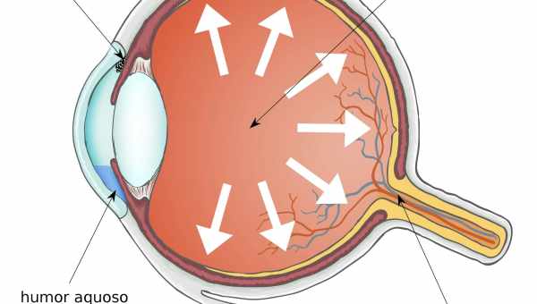 Эта коварная глаукома