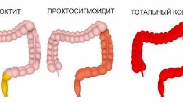 Воспаление прямой кишки: причины, симптомы, возможные осложнения. Методы лечения воспаления прямой кишки