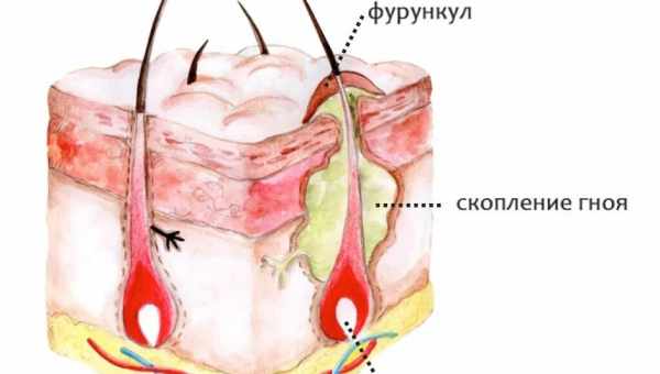 Воспаление сальных желез: причины, симптомы, возможные осложнения. Методы лечения воспаления сальных желез