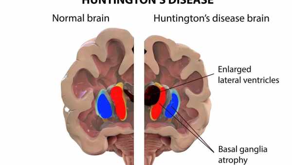 Прогрессирующая болезнь Хантингтона укоротила теломеры пациентов