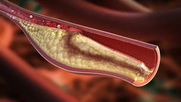 Очищение крови от холестерина