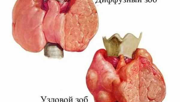 Лечение диффузного эутиреоидного зоба при помощи тироксина