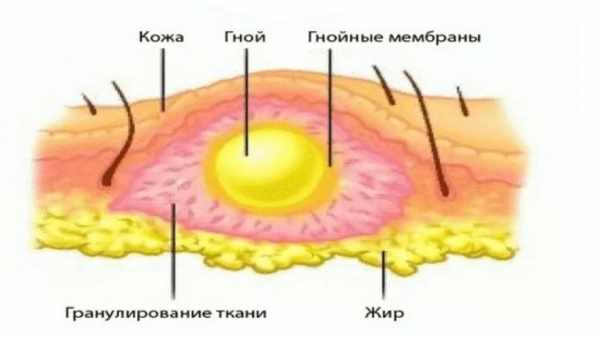 Флегмона шеи