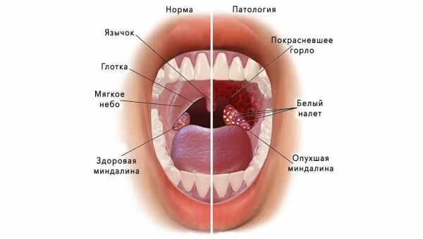 Лечение ангины народными средствами