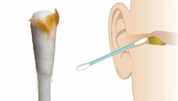 Чистка уха ватной палочкой привела к внутричерепному абсцессу