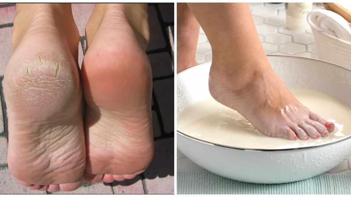 Як позбутися сухої шкіри ніг
